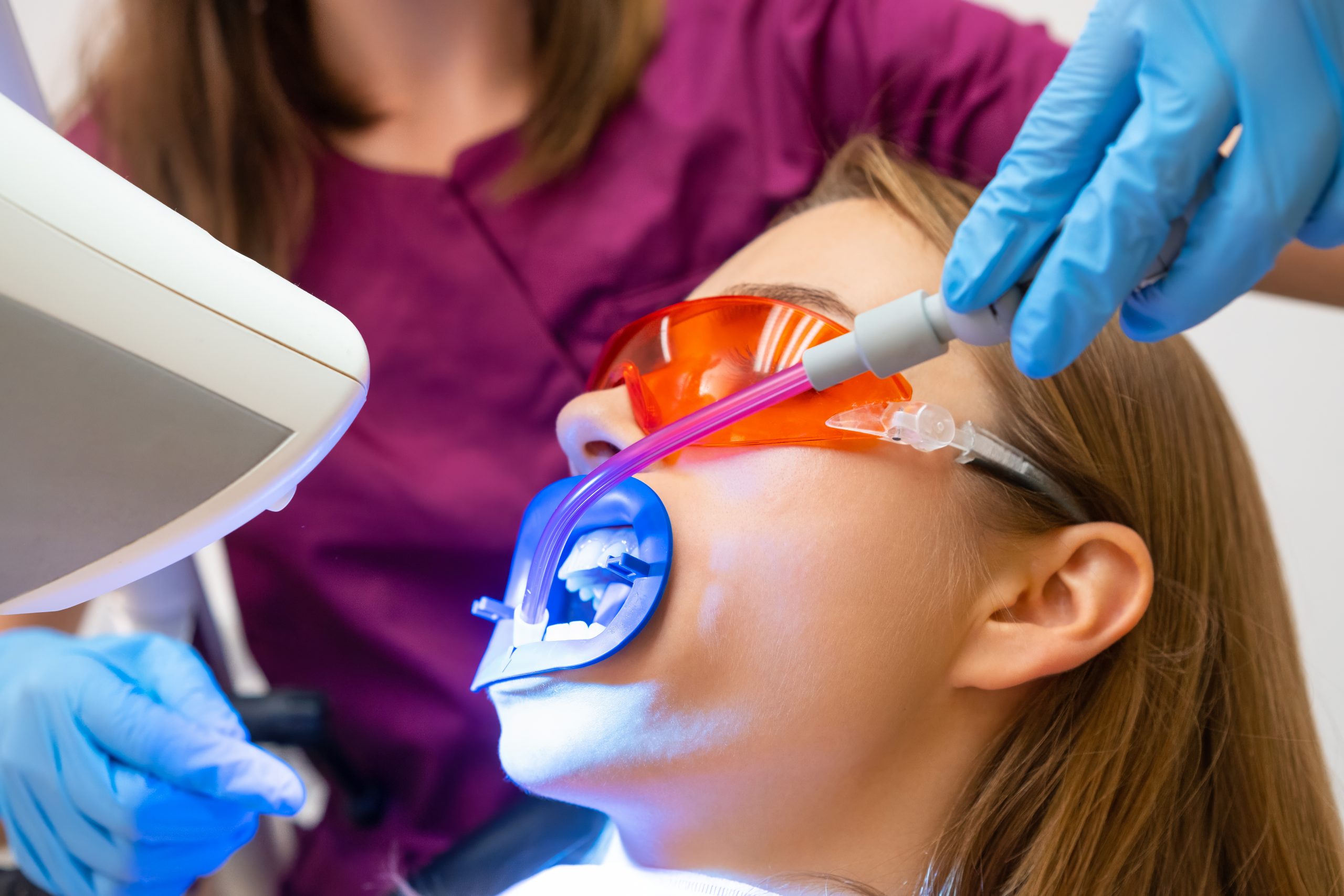 تبييض الأسنان